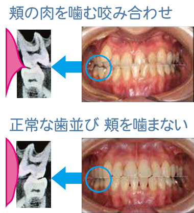 人 親知らず 生え ない