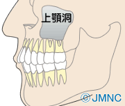 上顎洞は上の奥歯のすぐ上にあります